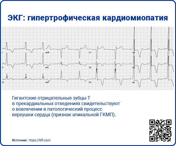 ЭКГ гипертрофическая кардиомиопатия